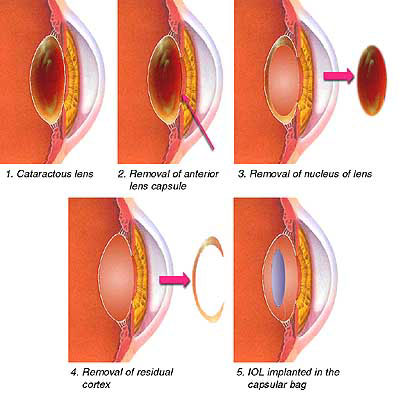 These drawings show the procedure.